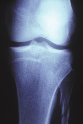Il vit pendant 50 ans avec une jambe cassée !